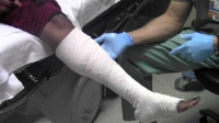 Dynarex® - Unna Boot Bandage - 3453 - In Use