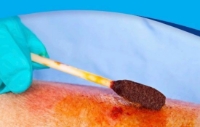 Dynarex® - Cotton Tipped Applicator - 4302 - In Use